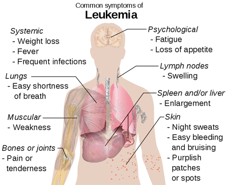 Experimental treatment sends deadly leukemia into remission 