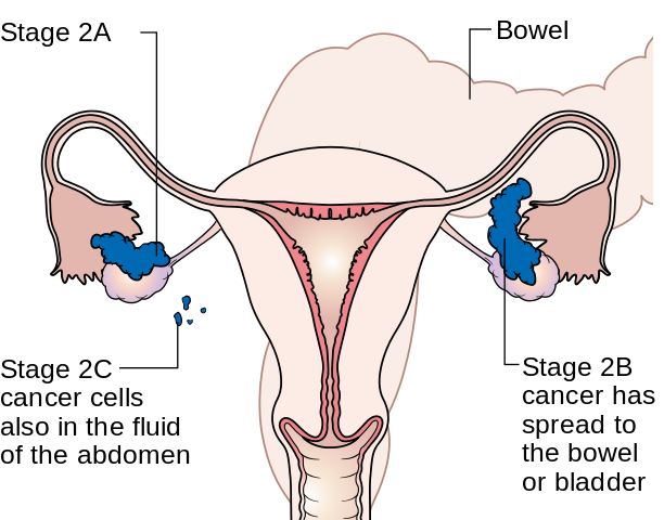 Diagram_showing_stage_2A_to_2C_ovarian_cancer_CRUK_214.svg