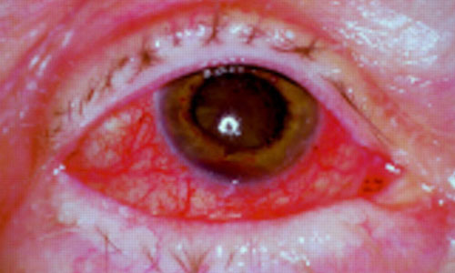 scleritis and episcleritis