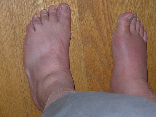 Difference Between Gout And Osteoarthritis Difference Between