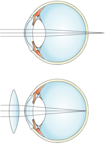 Difference Between Myopia and Hypermetropia | Difference Between