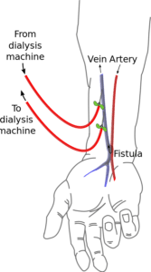 Difference Between Fistula and Fissure | Difference Between | Fistula