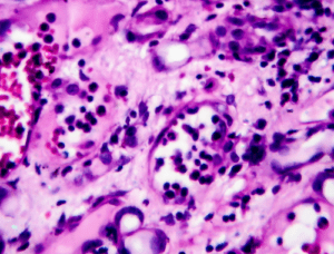 Difference Between Chronic Glomerulonephritis and Chronic Interstitial ...