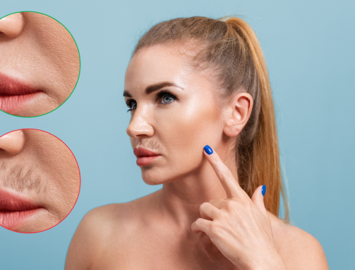 Difference Between Hypertrichosis And Hirsutism Difference Between Difference Between Hypertrichosis And Hirsutism Difference Between
