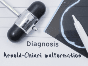 Difference Between Arnold-Chiari Malformation Type 1 and Type 2 ...