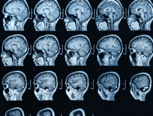 Difference Between Runny Nose and Brain Fluid | Difference Between